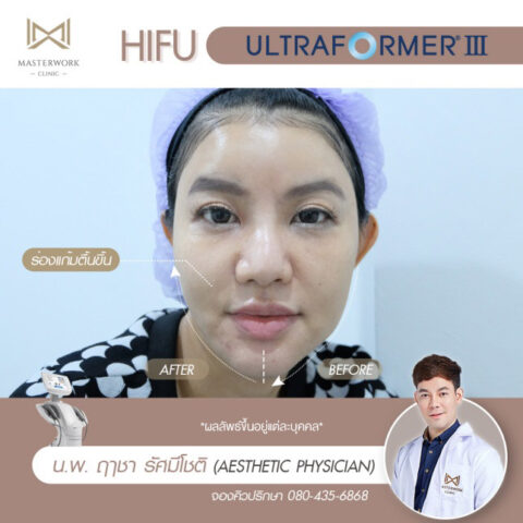 2ทำ-hifu-ที่ไหนดี-รีวิว-hifu-mmfu-masterwork-clinic