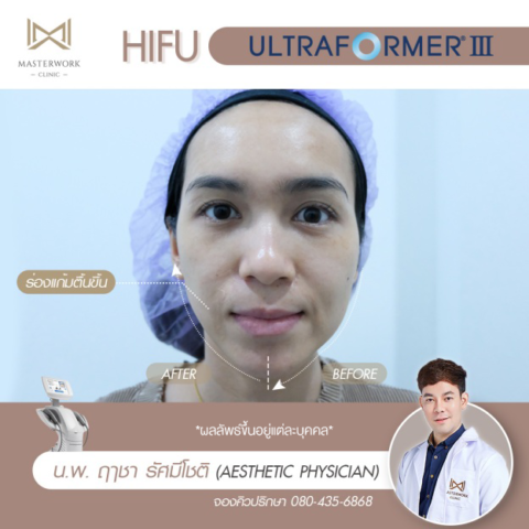 4ทำ-hifu-ที่ไหนดี-รีวิว-hifu-mmfu-masterwork-clinic