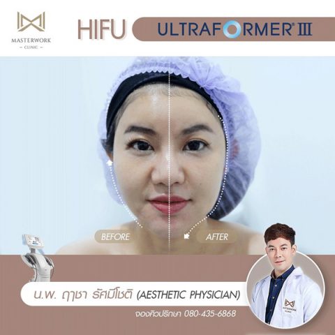 hifu mmfu hifu ที่ดีที่สุด เห็นผลชัดสุด masterwork clinic00001