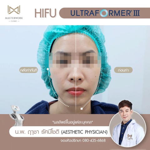 hifu-mmfu-hifu-ที่ดีที่สุด-เห็นผลชัดสุด-masterwork-clinic00006