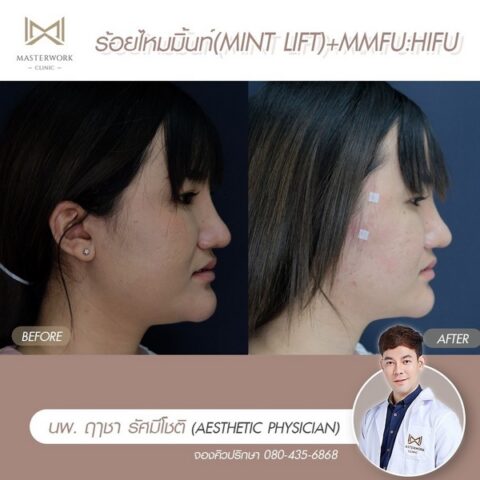 คลินิกร้อยไหม รีวิวไหมมิ้นท์ MINT masterwork clinic00004