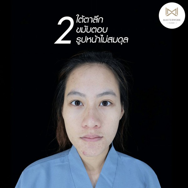ฉีดไขมัน ไขมันตัวเอง ฉีดไขมันหน้าเด็ก masterwork clinic00017