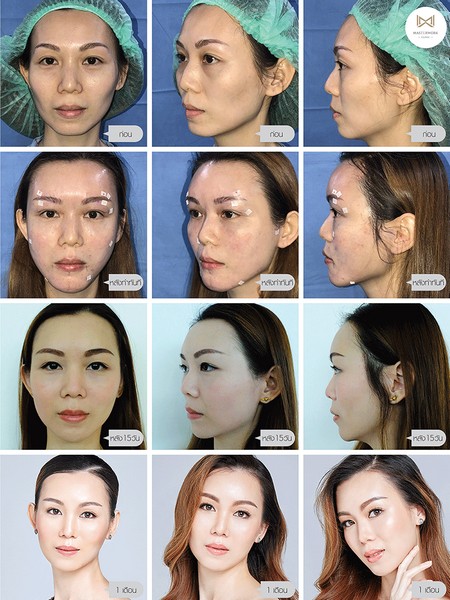 ฉีดไขมัน ไขมันตัวเอง ฉีดไขมันหน้าเด็ก masterwork clinic00019