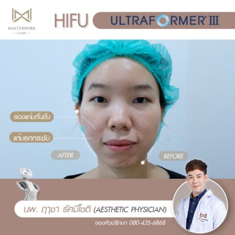 ทำ hifu ที่ไหนดี รีวิว hifu mmfu masterwork clinic