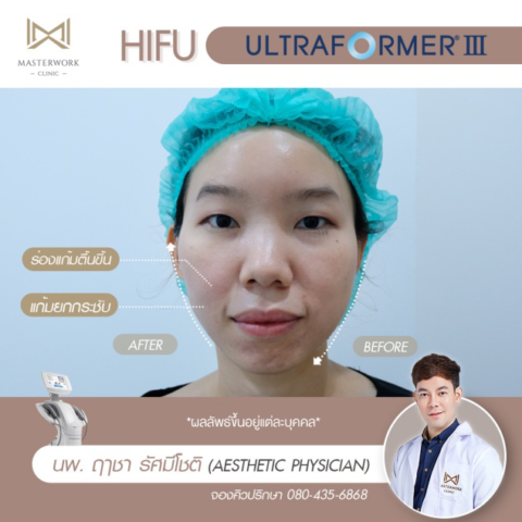 ทำ-hifu-ที่ไหนดี-รีวิว-hifu-mmfu-masterwork-clinic