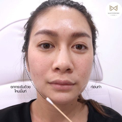 ร้อยไหม mint ไหมผ่าน อย. ยกกระชับหน้า ร้อยไหมที่ไหนดี masterwork clinic00021