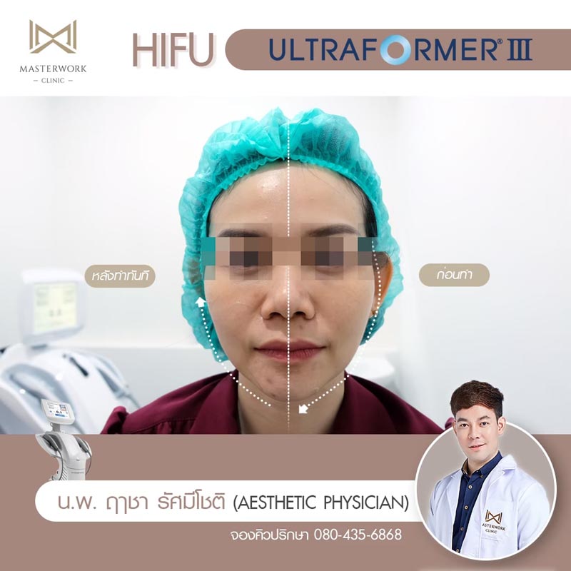 รีวิว hifu ultraformer iii โปรโมชั่น hifu Masterwork clinic10