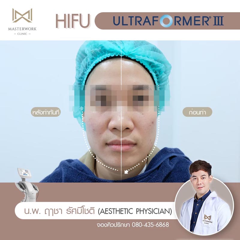 รีวิว hifu ultraformer iii โปรโมชั่น hifu Masterwork clinic11