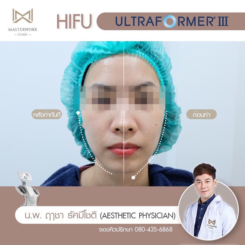 รีวิว hifu ultraformer iii โปรโมชั่น hifu Masterwork clinic12