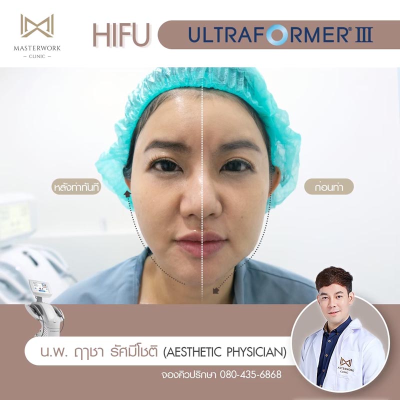 รีวิว hifu ultraformer iii โปรโมชั่น hifu Masterwork clinic13