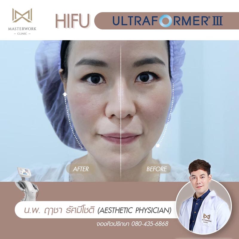 รีวิว hifu ultraformer iii โปรโมชั่น hifu Masterwork clinic4