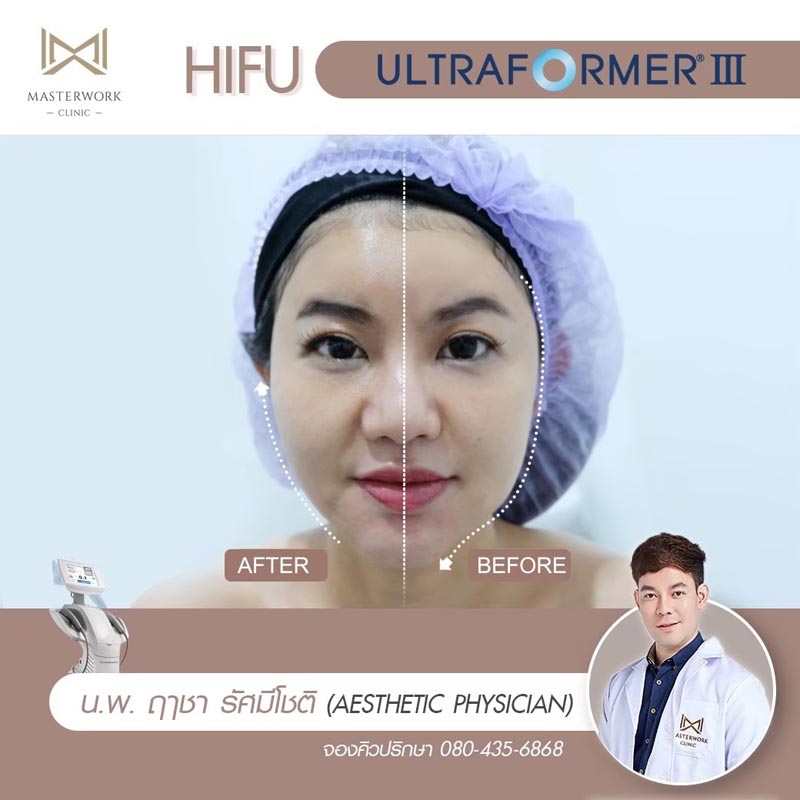รีวิว hifu ultraformer iii โปรโมชั่น hifu Masterwork clinic5