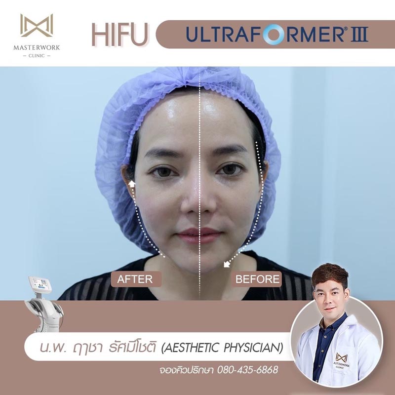 รีวิว hifu ultraformer iii โปรโมชั่น hifu Masterwork clinic6