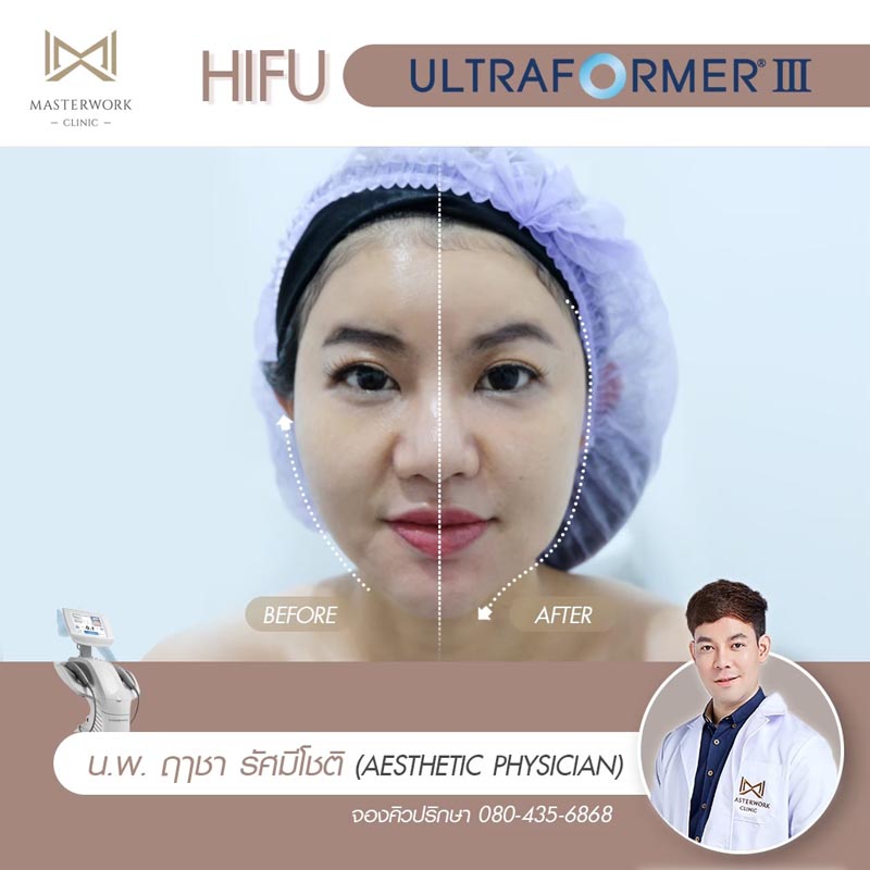 รีวิว hifu ultraformer iii โปรโมชั่น hifu Masterwork clinic7