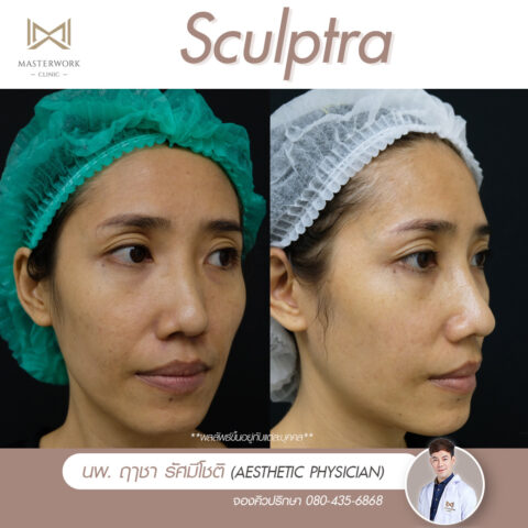 หลังฉีด sculptra, sculptra รีวิว