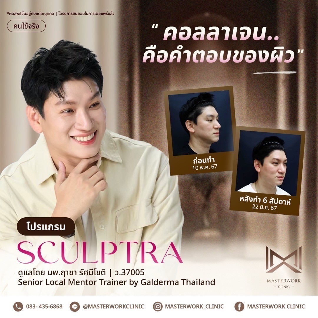 โปรแกรม Sculptra