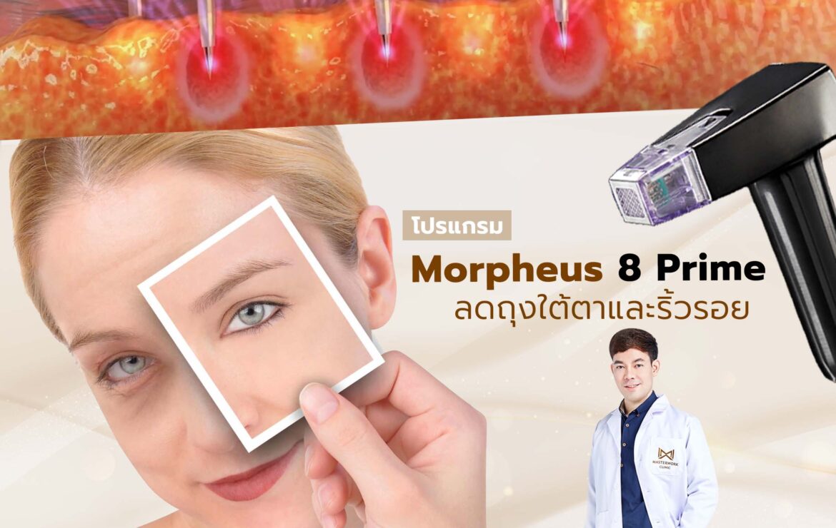 โปรแกรม Morpheus 8 Prime เพื่อผิวใต้ตาเรียบเนียน ลดขนาดถุงใต้ตาและลดริ้วรอยรอบดวงตา