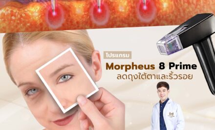 โปรแกรม Morpheus 8 Prime เพื่อผิวใต้ตาเรียบเนียน ลดขนาดถุงใต้ตาและลดริ้วรอยรอบดวงตา