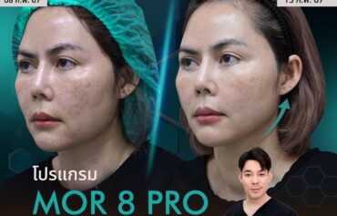 MOR 8 PRO ยกกระชับผิว