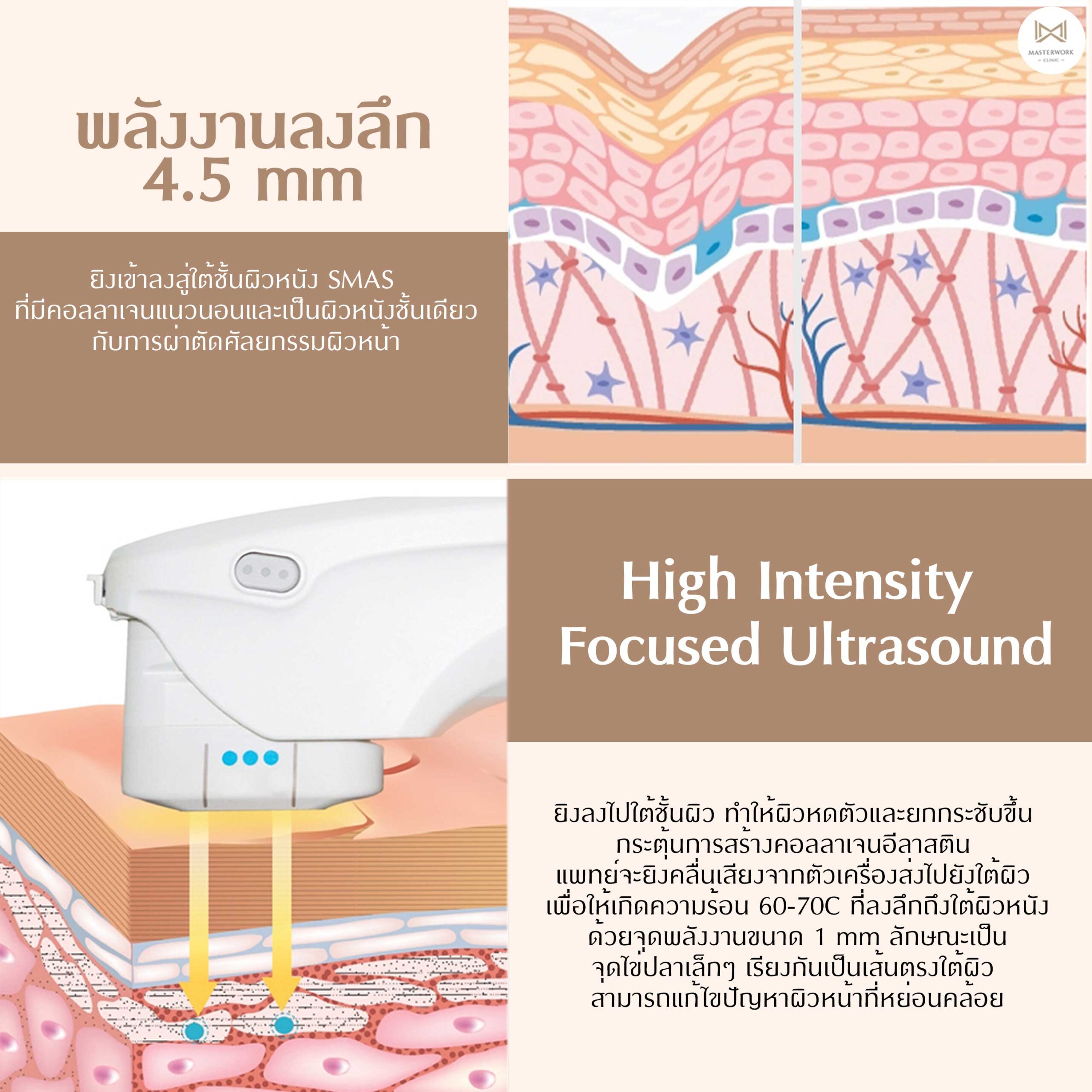 Ulthera SPT หลักการทํางาน, Ulthera SPT ยกกระชับ กระตุ้นคอลลาเจน