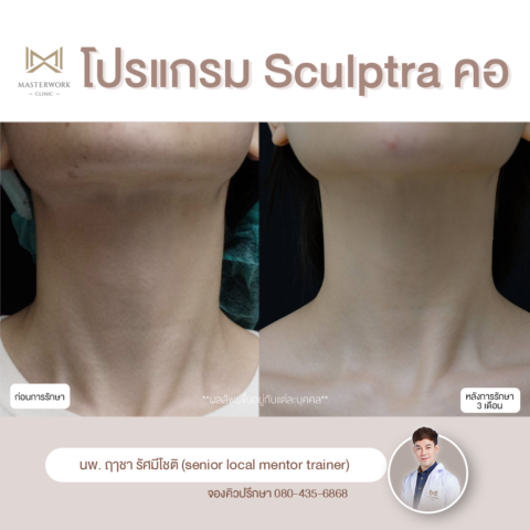 Sculptra-2