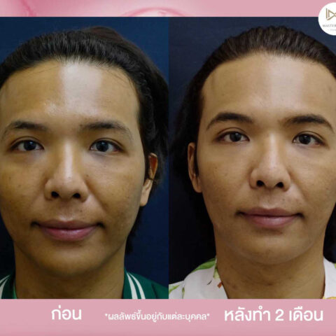 รีวิว-sculptra-3