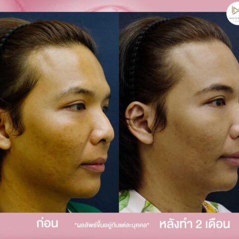 รีวิว-sculptra-4