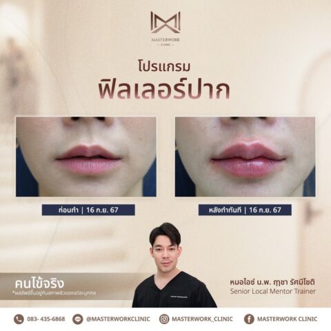 LINE_ALBUM_บทความ ฟิลเลอร์ปาก_250601_1