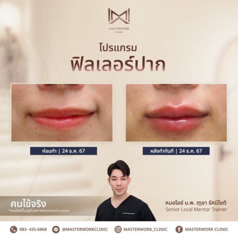 LINE_ALBUM_บทความ ฟิลเลอร์ปาก_250601_2