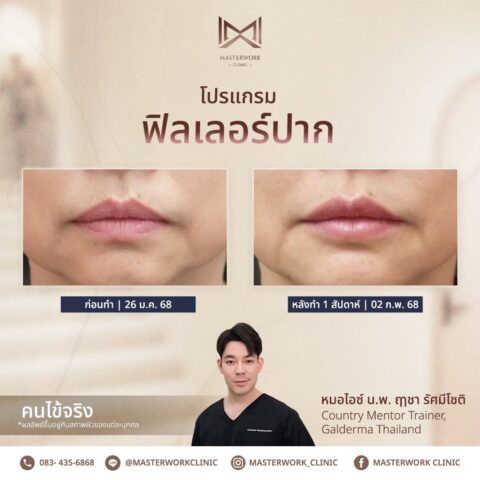 LINE_ALBUM_บทความ ฟิลเลอร์ปาก_250601_3