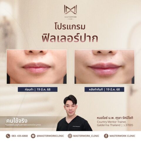 LINE_ALBUM_บทความ ฟิลเลอร์ปาก_250601_4