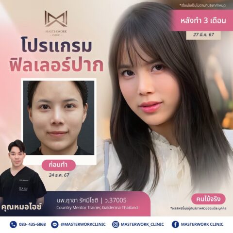 LINE_ALBUM_บทความ ฟิลเลอร์ปาก_250601_5