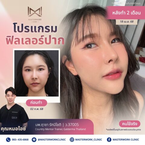 LINE_ALBUM_บทความ ฟิลเลอร์ปาก_250601_6