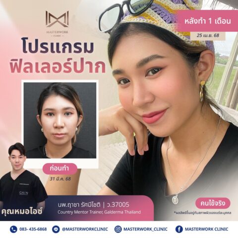 LINE_ALBUM_บทความ ฟิลเลอร์ปาก_250601_7