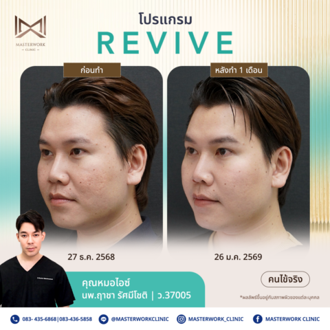 โปรแกรม REVIVE กับคุณหมอไอซ์ที่ MasterWork Clinic